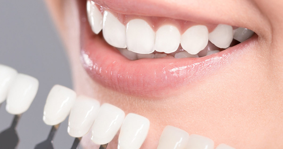 Teeth Whitening | Waverley Park Dental Care